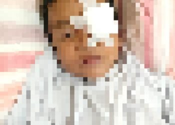 AH (9), menjadi korban saat menyaksikan kerumunan perang sarung. (dok. Pri)